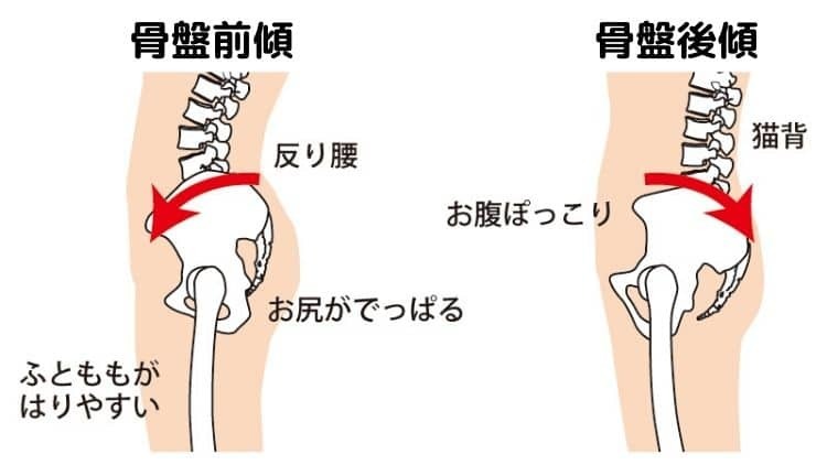 骨盤のゆがみの画像