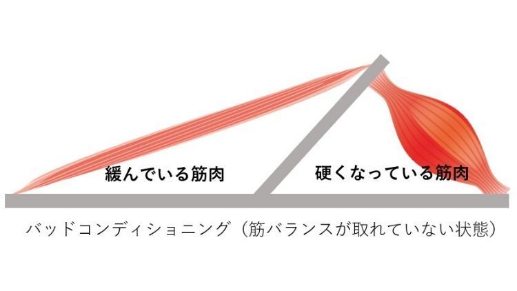 筋肉のバッドコンディショニング状態の写真